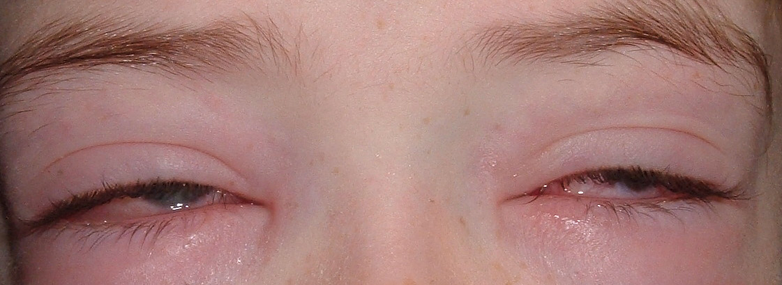Pediatric Ophthalmology Strabismus Education Resources
